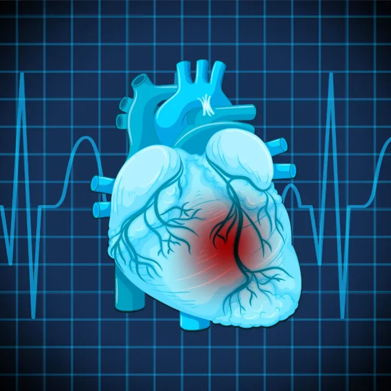 infarto y enfermedad cardiovascular